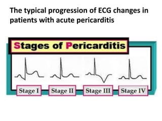 The typical progression of ECG changes in
patients with acute pericarditis
 