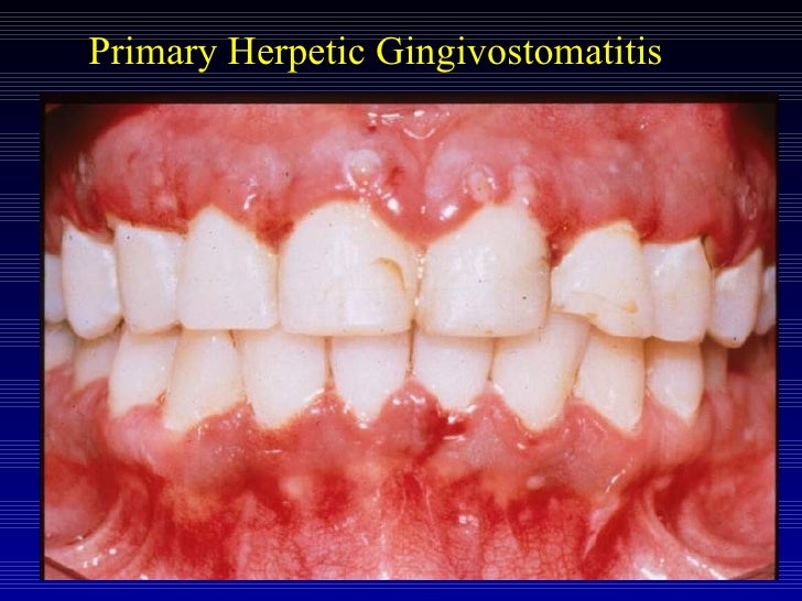Acute periodontal conditions