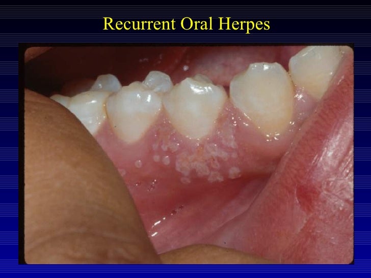Acute periodontal conditions
