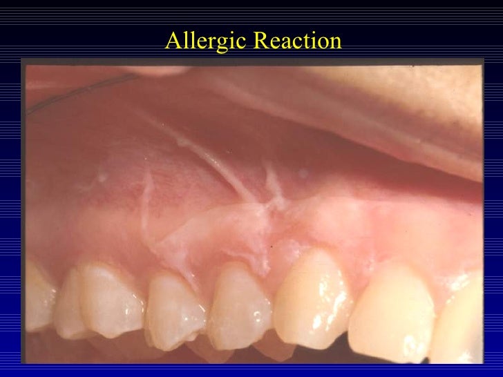 Acute periodontal conditions