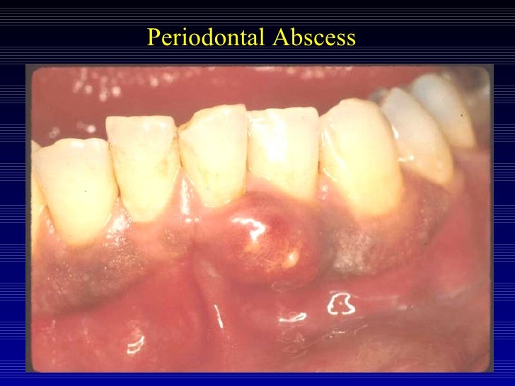 Acute periodontal conditions