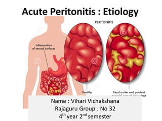 Acute Peritonitis : Etiology
Name : Vihari Vichakshana
Rajaguru Group : No 32
4th
year 2nd
semester
 