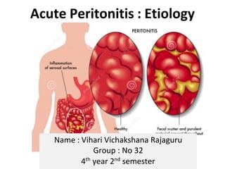Acute Peritonitis : Etiology
Name : Vihari Vichakshana Rajaguru
Group : No 32
4th
year 2nd
semester
 