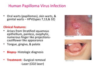 Human Papilloma Virus Infection 
• Oral warts (papillomas), skin warts, & 
genital warts – HPV(types 7,13,& 32) 
Clinical Features: 
• Arises from Stratified squamous 
epithellium, painless, exophytic, 
numerous finger like projections-cauliflower 
like appearance 
• Tongue, gingiva, & palate 
• Biopsy- Histologic diagnosis 
• Treatment: -Surgical removal 
-Laser (CO2 laser) 
 