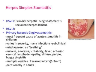 Herpes Simplex Stomatitis 
• HSV-1: Primary herpetic Gingivostomatitis 
Recurrent herpes labialis 
• HSV-2: 
• Primary herpetic Gingivostomatitis: 
-most frequent cause of acute stomatitis in 
children 
-varies in severity, many infections -subclinical 
-misdiagnosed as “teething” 
-malaise, anorexia, irritability, fever, anterior 
cervical lymphadenopathy, diffuse, purple, 
boggy gingivitis 
-multiple vesicles scarred ulcers(1-3mm) 
-occasionally in adults 
 