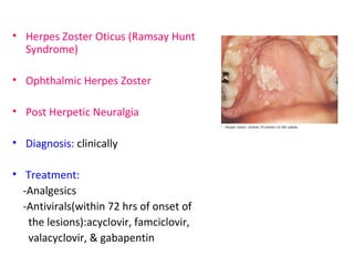 • Herpes Zoster Oticus (Ramsay Hunt 
Syndrome) 
• Ophthalmic Herpes Zoster 
• Post Herpetic Neuralgia 
• Diagnosis: clinically 
• Treatment: 
-Analgesics 
-Antivirals(within 72 hrs of onset of 
the lesions):acyclovir, famciclovir, 
valacyclovir, & gabapentin 
 