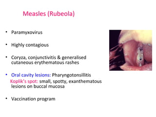 Measles (Rubeola) 
• Paramyxovirus 
• Highly contagious 
• Coryza, conjunctivitis & generalised 
cutaneous erythematous rashes 
• Oral cavity lesions: Pharyngotonsillitis 
Koplik’s spot: small, spotty, exanthematous 
lesions on buccal mucosa 
• Vaccination program 
 