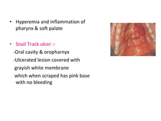 • Hyperemia and inflammation of 
pharynx & soft palate 
• Snail Track ulcer :- 
-Oral cavity & oropharnyx 
-Ulcerated lesion covered with 
grayish white membrane 
which when scraped has pink base 
with no bleeding 
 