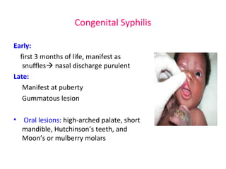 Congenital Syphilis 
Early: 
first 3 months of life, manifest as 
snuffles nasal discharge purulent 
Late: 
Manifest at puberty 
Gummatous lesion 
• Oral lesions: high-arched palate, short 
mandible, Hutchinson’s teeth, and 
Moon’s or mulberry molars 
 