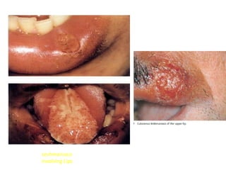 Leshmaniasis 
involving Lips 
 