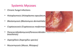 Systemic Mycoses 
• Chronic fungal infections 
• Histoplasmosis (Histoplasma capsulatum) 
• Blastomycosis (Blastomyces dermatitidis) 
• Cryptococcosis (Cryptococcus neoformans) 
• Paracoccidioidomycosis(Paracoccidioides 
brasiliensis) 
• Aspergillosis (Aspergillus species) 
• Mucormycosis (Mucor, Rhizopus) 
 