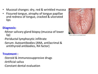 • Mucosal changes: dry, red & wrinkled mucosa 
• Fissured tongue, atrophy of tongue papillae 
and redness of tongue, cracked & ulcerated 
lips 
Diagnosis: 
-Minor salivary gland biopsy (mucosa of lower 
lip) 
-Periductal lymphocytic infiltrate 
-Serum: Autoantibodies (ANA, antilacrimal & 
antithyroid antibodies, RA factor) 
Treatment : 
-Steroid & immunossuppresive drugs 
-Artificial saliva 
-Constant dental evaluation 
 