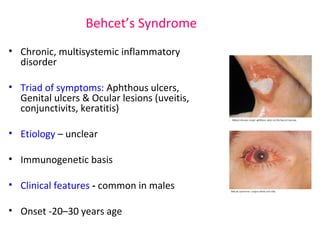 Behcet’s Syndrome 
• Chronic, multisystemic inflammatory 
disorder 
• Triad of symptoms: Aphthous ulcers, 
Genital ulcers & Ocular lesions (uveitis, 
conjunctivits, keratitis) 
• Etiology – unclear 
• Immunogenetic basis 
• Clinical features - common in males 
• Onset -20–30 years age 
 