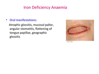 Iron Deficiency Anaemia 
• Oral manifestations: 
Atrophic glossitis, mucosal pallor, 
angular stomatitis, flattening of 
tongue papillae, geographic 
glossitis 
 