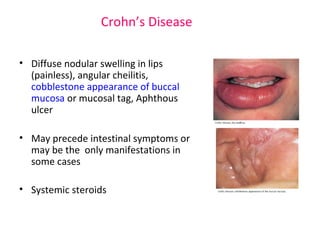 Crohn’s Disease 
• Diffuse nodular swelling in lips 
(painless), angular cheilitis, 
cobblestone appearance of buccal 
mucosa or mucosal tag, Aphthous 
ulcer 
• May precede intestinal symptoms or 
may be the only manifestations in 
some cases 
• Systemic steroids 
 