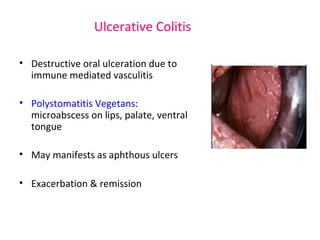 Ulcerative Colitis 
• Destructive oral ulceration due to 
immune mediated vasculitis 
• Polystomatitis Vegetans: 
microabscess on lips, palate, ventral 
tongue 
• May manifests as aphthous ulcers 
• Exacerbation & remission 
 