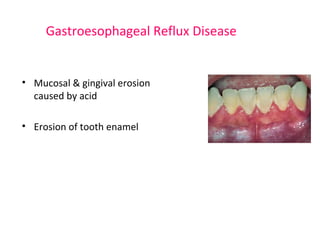 Gastroesophageal Reflux Disease 
• Mucosal & gingival erosion 
caused by acid 
• Erosion of tooth enamel 
 