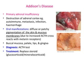 Addison’s Disease 
• Primary adrenal insufficiency 
• Destruction of adrenal cortex eg. 
autoimmune, metastasis, infection, 
haemorrhage 
• Oral manifestations: diffuse or patchy 
pigmentation of the skin & mucous 
membranes (due to increased ACTH-cross 
reacts with melanin receptors) 
• Buccal mucosa, palate, lips, & gingiva 
• Diagnosis: ACTH test 
• Treatment: Replace steroid 
(glucocorticoid/mineralocorticoid) 
 