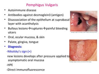 Pemphigus Vulgaris 
• Autoimmune disease 
• Antibodies against desmoglein3 (antigen) 
• Disassociation of the epithelium at suprabasal 
layer with acantholysis 
• Bullous lesionsrupturespainful bleeding 
ulcers 
• Oral, ocular mucosa, & skin 
• Palate, gingiva, tongue 
• Diagnosis: 
-Nikolsky’s sign:(+) 
new lesions develops after pressure applied to 
asymptomatic oral mucosa 
-HPE 
-Direct immunofluorescence 
 
