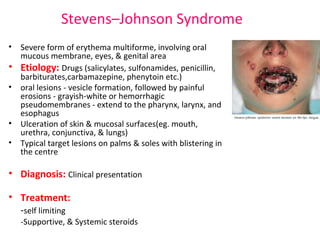 Stevens–Johnson Syndrome 
• Severe form of erythema multiforme, involving oral 
mucous membrane, eyes, & genital area 
• Etiology: Drugs (salicylates, sulfonamides, penicillin, 
barbiturates,carbamazepine, phenytoin etc.) 
• oral lesions - vesicle formation, followed by painful 
erosions - grayish-white or hemorrhagic 
pseudomembranes - extend to the pharynx, larynx, and 
esophagus 
• Ulceration of skin & mucosal surfaces(eg. mouth, 
urethra, conjunctiva, & lungs) 
• Typical target lesions on palms & soles with blistering in 
the centre 
• Diagnosis: Clinical presentation 
• Treatment: 
-self limiting 
-Supportive, & Systemic steroids 
 
