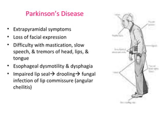 Parkinson’s Disease 
• Extrapyramidal symptoms 
• Loss of facial expression 
• Difficulty with mastication, slow 
speech, & tremors of head, lips, & 
tongue 
• Esophageal dysmotility & dysphagia 
• Impaired lip seal drooling fungal 
infection of lip commissure (angular 
cheilitis) 
 