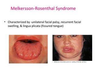 Melkersson-Rosenthal Syndrome 
• Characterized by -unilateral facial palsy, recurrent facial 
swelling, & lingua plicata (fissured tongue) 
 