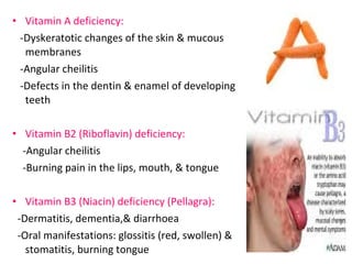 • Vitamin A deficiency: 
-Dyskeratotic changes of the skin & mucous 
membranes 
-Angular cheilitis 
-Defects in the dentin & enamel of developing 
teeth 
• Vitamin B2 (Riboflavin) deficiency: 
-Angular cheilitis 
-Burning pain in the lips, mouth, & tongue 
• Vitamin B3 (Niacin) deficiency (Pellagra): 
-Dermatitis, dementia,& diarrhoea 
-Oral manifestations: glossitis (red, swollen) & 
stomatitis, burning tongue 
 