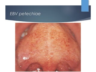 EBV petechiae
 