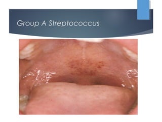 Group A Streptococcus
 