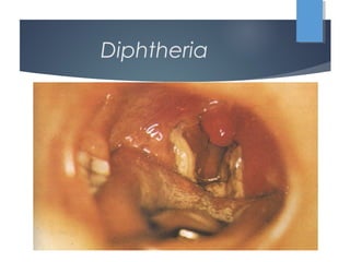 Diphtheria
 