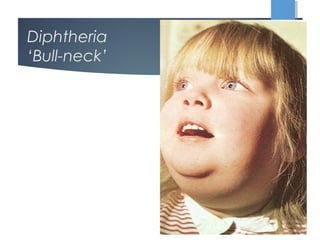 Diphtheria
‘Bull-neck’
 
