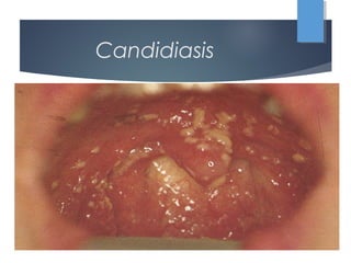 Candidiasis
 