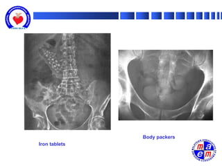 Body packers
Iron tablets
 