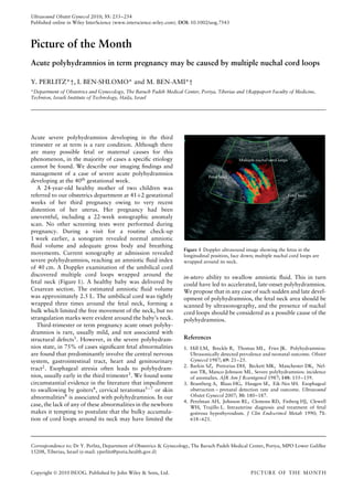 Ultrasound Obstet Gynecol 2010; 35: 253–254
Published online in Wiley InterScience (www.interscience.wiley.com). DOI: 10.1002/uog.7543



Picture of the Month
Acute polyhydramnios in term pregnancy may be caused by multiple nuchal cord loops

Y. PERLITZ*†, I. BEN-SHLOMO* and M. BEN-AMI*†
*Department of Obstetrics and Gynecology, The Baruch Padeh Medical Center, Poriya, Tiberias and †Rappaport Faculty of Medicine,
Technion, Israeli Institute of Technology, Haifa, Israel




Acute severe polyhydramnios developing in the third
trimester or at term is a rare condition. Although there
are many possible fetal or maternal causes for this
phenomenon, in the majority of cases a speciﬁc etiology                                        Multiple nuchal cord loops
cannot be found. We describe our imaging ﬁndings and
management of a case of severe acute polyhydramnios                             Fetal head
developing at the 40th gestational week.
   A 24-year-old healthy mother of two children was
referred to our obstetrics department at 41+2 gestational                                                                   Fetal body
weeks of her third pregnancy owing to very recent
distention of her uterus. Her pregnancy had been
uneventful, including a 22-week sonographic anomaly
scan. No other screening tests were performed during
pregnancy. During a visit for a routine check-up
1 week earlier, a sonogram revealed normal amniotic
ﬂuid volume and adequate gross body and breathing
                                                                     Figure 1 Doppler ultrasound image showing the fetus in the
movements. Current sonography at admission revealed                  longitudinal position, face down; multiple nuchal cord loops are
severe polyhydramnios, reaching an amniotic ﬂuid index               wrapped around its neck.
of 40 cm. A Doppler examination of the umbilical cord
discovered multiple cord loops wrapped around the                    in-utero ability to swallow amniotic ﬂuid. This in turn
fetal neck (Figure 1). A healthy baby was delivered by               could have led to accelerated, late-onset polyhydramnios.
Cesarean section. The estimated amniotic ﬂuid volume                 We propose that in any case of such sudden and late devel-
was approximately 2.5 L. The umbilical cord was tightly              opment of polyhydramnios, the fetal neck area should be
wrapped three times around the fetal neck, forming a                 scanned by ultrasonography, and the presence of nuchal
bulk which limited the free movement of the neck, but no             cord loops should be considered as a possible cause of the
strangulation marks were evident around the baby’s neck.             polyhydramnios.
   Third-trimester or term pregnancy acute onset polyhy-
dramnios is rare, usually mild, and not associated with
structural defects1 . However, in the severe polyhydram-             References
nios state, in 75% of cases signiﬁcant fetal abnormalities           1. Hill LM, Breckle R, Thomas ML, Fries JK. Polyhydramnios:
are found that predominantly involve the central nervous                Ultrasonically detected prevalence and neonatal outcome. Obstet
system, gastrointestinal tract, heart and genitourinary                 Gynecol 1987; 69: 21–25.
                                                                     2. Barkin SZ, Pretorius DH, Beckett MK, Manchester DK, Nel-
tract2 . Esophageal atresia often leads to polyhydram-
                                                                        son TR, Manco-Johnson ML. Severe polyhydramnios: incidence
nios, usually early in the third trimester3 . We found some             of anomalies. AJR Am J Roentgenol 1987; 148: 155–159.
circumstantial evidence in the literature that impediment            3. Brantberg A, Blaas HG, Haugen SE, Eik-Nes SH. Esophageal
to swallowing by goiters4 , cervical teratomas5 – 7 or skin             obstruction – prenatal detection rate and outcome. Ultrasound
abnormalities8 is associated with polyhydramnios. In our                Obstet Gynecol 2007; 30: 180–187.
                                                                     4. Perelman AH, Johnson RL, Clemons RD, Finberg HJ, Clewell
case, the lack of any of these abnormalities in the newborn             WH, Trujillo L. Intrauterine diagnosis and treatment of fetal
makes it tempting to postulate that the bulky accumula-                 goitrous hypothyroidism. J Clin Endocrinol Metab 1990; 71:
tion of cord loops around its neck may have limited the                 618–621.




Correspondence to: Dr Y. Perlitz, Department of Obstetrics & Gynecology, The Baruch Padeh Medical Center, Poriya, MPO Lower Galillee
15208, Tiberias, Israel (e-mail: yperlitz@poria.health.gov.il)



Copyright  2010 ISUOG. Published by John Wiley & Sons, Ltd.                                         PICTURE OF THE MONTH
 