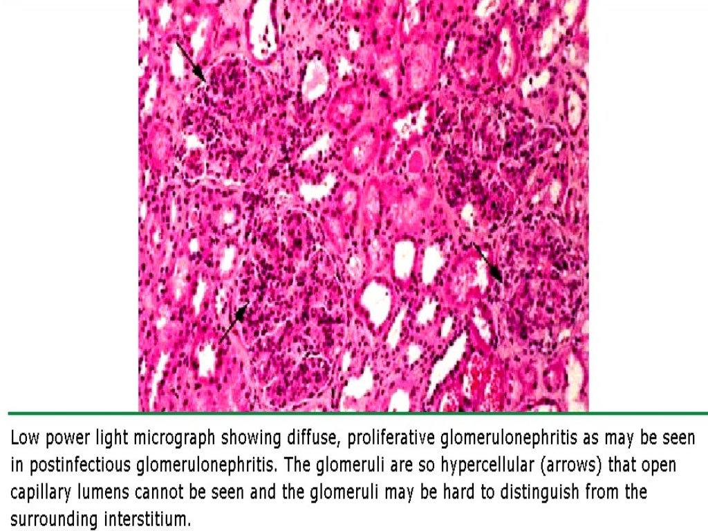Acute post streptococcal glomerulonephritis