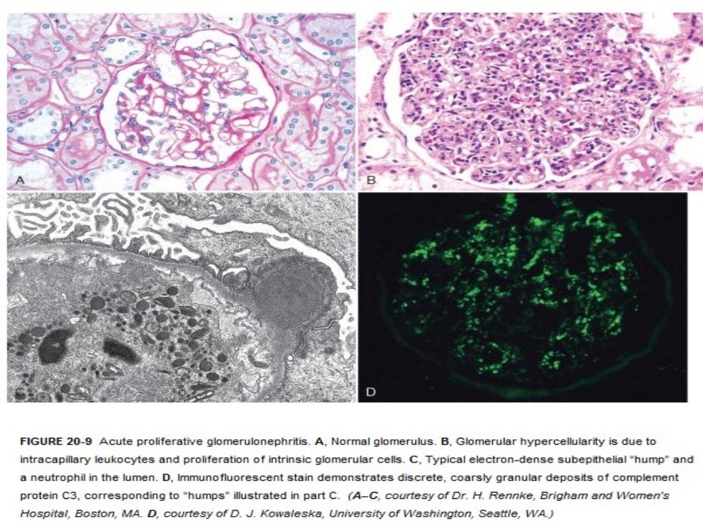 Acute post streptococcal glomerulonephritis