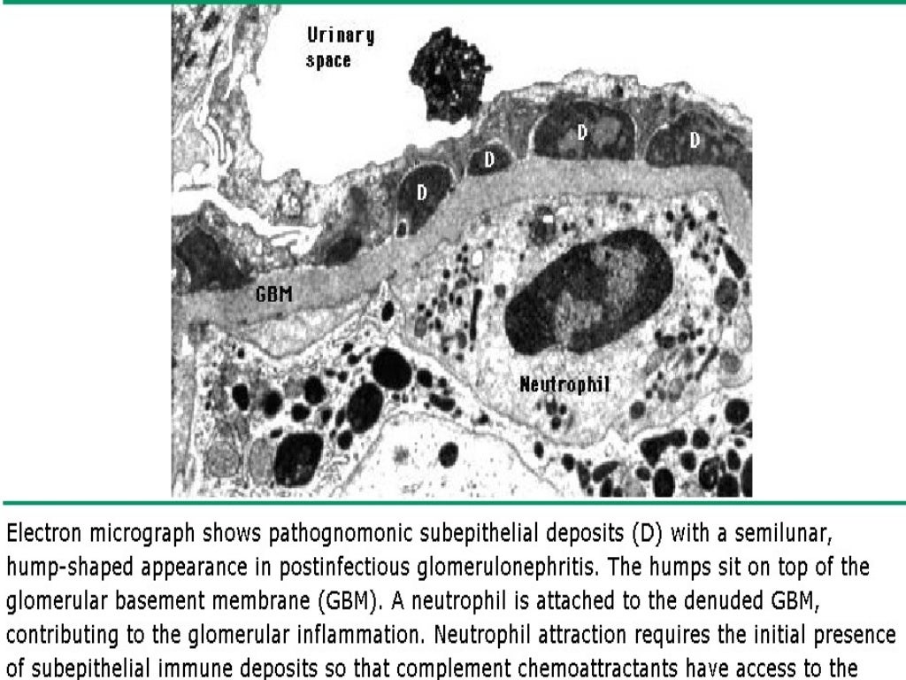 Acute post streptococcal glomerulonephritis