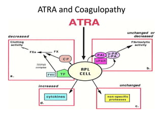 Acute promyelocytic leukemia | PPTX
