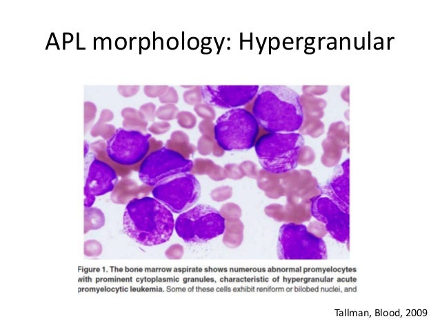 Acute promyelocytic leukemia