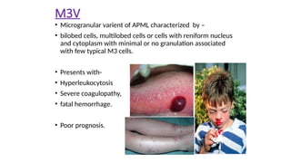 M3V
• Microgranular varient of APML characterized by –
• bilobed cells, multilobed cells or cells with reniform nucleus
and cytoplasm with minimal or no granulation associated
with few typical M3 cells.
• Presents with-
• Hyperleukocytosis
• Severe coagulopathy,
• fatal hemorrhage.
• Poor prognosis.
 