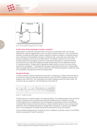70
     Fig 15. The normal ECG complex from the P-T waves


     A brief review of the physiology of cardiac conduction
     Depolarization of ventricular myocardial cells is the result of a rapid influx of Na+ ions through
     selective Na+ channels. Repolarization occurs via cationic inflows through Ca++, Na+, and several K+
     channels, including the hERG gene coded IKr potassium channel (a complex of 4 identical subunits
     each containing 6 transmembrane domains, numbered S1-S6, a pore helix and a slide helix). This
     process is reflected on the ECG by the QRS interval. The hERG/IKr channel is the most critical
     in drug-induced QTc prolongation syndromes. Drugs which blocking the IKr channel prolong the
     QTc interval and can induce life threatening cardiac arrhythmmias, the most significant of which
     is ‘torsade de pointes’. Sudden death in apparently healthy adults can occur as a result of drug
     induced QTc prolongation.103 Prolonged QTc intervals are associated with the risk of sudden death
     after myocardial infarction and the “long QT syndrome”. QTc interval prolongation is a flag that warns
     of the possibility of torsade de pointes and sudden death.

     Torsade de Pointes
     Torsade de pointes meaning “twisting around the point” (a reference to a ballet movement) refers to
     an uncommon variant of ventricular tachycardia (VT) in which the QRS complexes twist about the
     isoelectric axis of the ECG. The morphology of the QRS complexes varies from beat to beat. The
     ventricular rate can range from 150-250 beats per minute (Fig 16).




     Figure 16 – Torsade de pointes


     The QTc interval is a modest predictor of torsade de pointes. The underlying basis for the arrhythmia
     is delay in phase III of the myocardial action potential mediated by the IKr potassium channel.
     This prolonged period of repolarization and the irregularity of repolarization times among different
     myocardial fibers create re-entrant phenomena or ectopic electrical activity to occur, producing the
     arrhythmia. As the underlying etiology and management of torsade are, in general, quite different
     from VT, the management of torsade with group IA antiarrhythmic drugs can be lethal.
     There are familial predispositons to torsade de points, mediated by 6 genetic variants of the hERG/IKr
     channel, producing the “long QT syndrome”.




     103.
            Witchel HJ, Hancox JC. Familial and acquired long QT syndrome and the cardiac rapid delayed rectifier potassium current.
            Clinical and Experimental Pharmacology and Physiology 2000; 27:753-776
 