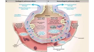 Acute pulmonary edema and its causes .pptx