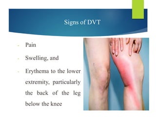 Signs of DVT
- Pain
- Swelling, and
- Erythema to the lower
extremity, particularly
the back of the leg
below the knee
 
