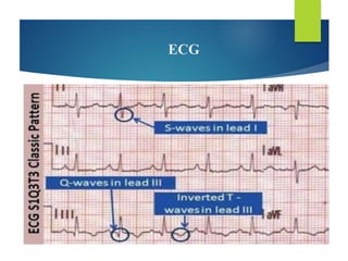 ECG
 