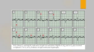 ABDULRAHMAN AL RAFIQ UPDATED MANAGEMENT OF ACUTE PULMONARY EMBOLISM .pdf