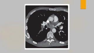 ABDULRAHMAN AL RAFIQ UPDATED MANAGEMENT OF ACUTE PULMONARY EMBOLISM .pdf