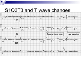 S1Q3T3 and T wave changes
 