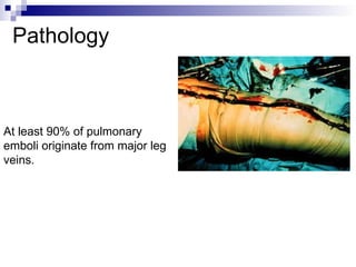 Pathology
At least 90% of pulmonary
emboli originate from major leg
veins.
 