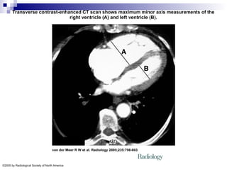 Transverse contrast-enhanced CT scan shows maximum minor axis measurements of the
right ventricle (A) and left ventricle (B).
van der Meer R W et al. Radiology 2005;235:798-803
©2005 by Radiological Society of North America
 