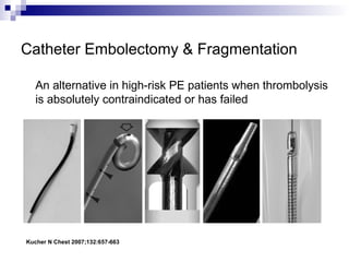 Catheter Embolectomy & Fragmentation
An alternative in high-risk PE patients when thrombolysis
is absolutely contraindicated or has failed
Kucher N Chest 2007;132:657-663
 